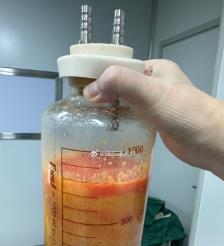 内江水动力吸脂手术要做多久？